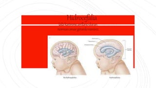 Hidrocefalia
lailakarimmearellanoduran
normanomargerardoramirez
 