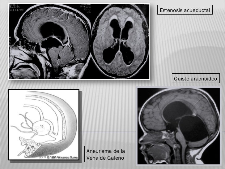 ESTENOSIS DEL ACUEDUCTO DE SILVIO DOWNLOAD ESTENOSIS DEL ACUEDUCTO DE SILVIO DOWNLOAD
