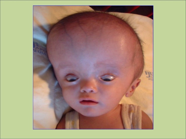 Hidrocefalia congénita