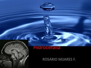 Hidrocefalia
ROSARIO MIJARES F.
 
