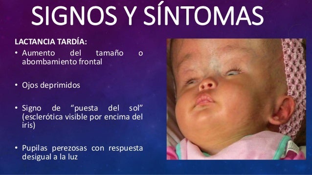 Hidrocefalia