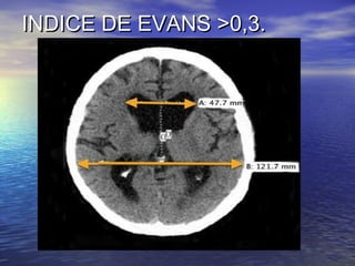 INDICE DE EVANS >0,3.INDICE DE EVANS >0,3.
 