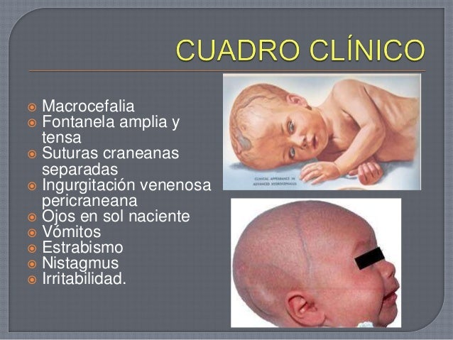 Hidrocefalia pediatrica gavilanes aguilar