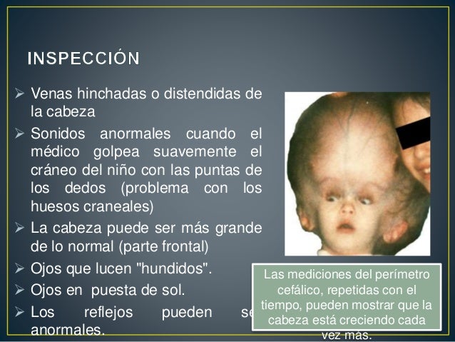 Hidrocefalia seminario
