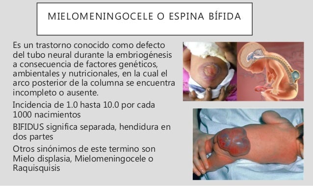 hidrocefalia-y-mielomeningocele