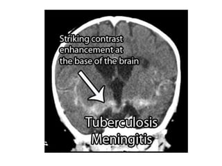Hidrocephalus post infection