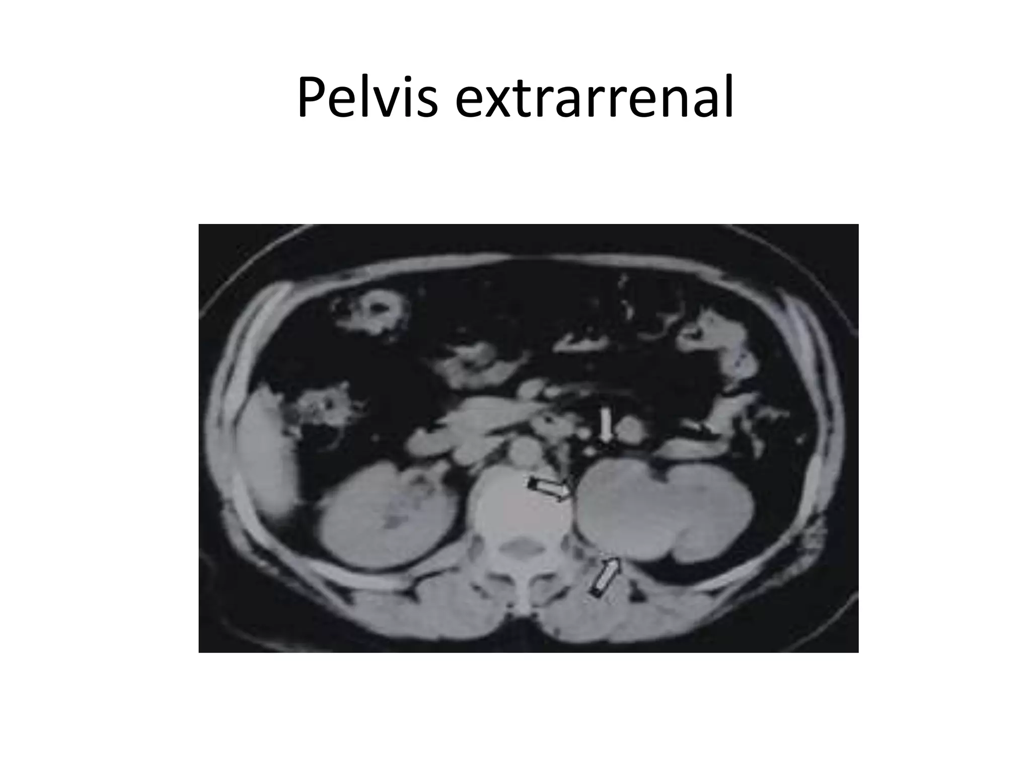 Pelvis extrarrenal
 