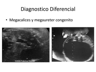 Diagnostico Diferencial
• Megacalices y megaureter congenito
 