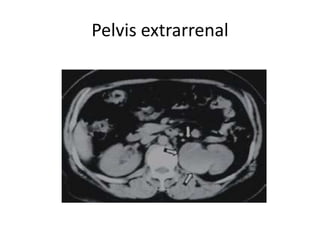 Pelvis extrarrenal
 