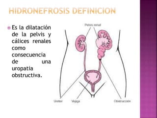  Es la dilatación
de la pelvis y
cálices renales
como
consecuencia
de una
uropatia
obstructiva.
 