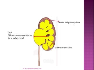 DAP
Diámetro anteroposterior
de la pelvis renal
Diámetro del cáliz
Grosor del parénquima
HTTP://jesusgraciaromero.com
 