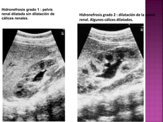 Hidronefrosis grado 1 : pelvis
renal dilatada sin dilatación de
cálices renales.
Hidronefrosis grado 2 : dilatación de la ...