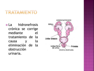  La hidronefrosis
crónica se corrige
mediante el
tratamiento de la
causa y la
eliminación de la
obstrucción
urinaria.
 