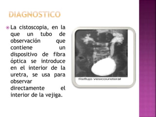  La cistoscopia, en la
que un tubo de
observación que
contiene un
dispositivo de fibra
óptica se introduce
en el interior...