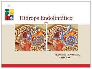 FRANCISCO OLIVARES M. 14 ABRIL 2011 Hidrops Endolinfático 