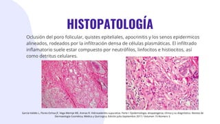 Revisión del tema dermatología pregrado idrosadenitis supurativa.pdf