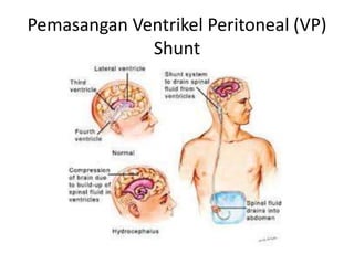 Pemasangan Ventrikel Peritoneal (VP)
Shunt
 