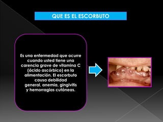 QUE ES EL ESCORBUTO

Es una enfermedad que ocurre
cuando usted tiene una
carencia grave de vitamina C
(ácido ascórbico) en la
alimentación. El escorbuto
causa debilidad
general, anemia, gingivitis
y hemorragias cutáneas.

 
