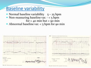 Baseline Variability Definition HIE.pptx