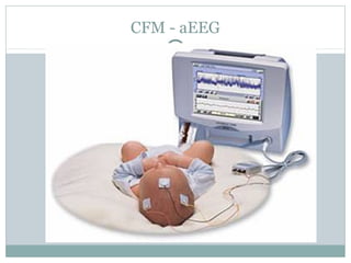 CFM - aEEG
 
