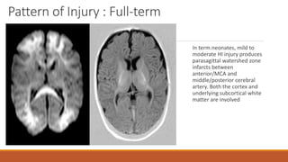 Pattern of Injury : Full-term
In term neonates, mild to
moderate HI injury produces
parasagittal watershed zone
infarcts between
anterior/MCA and
middle/posterior cerebral
artery. Both the cortex and
underlying subcortical white
matter are involved
 