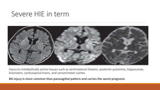 Severe HIE in term
Injury to metabolically active tissues such as ventrolateral thalami, posterior putamina, hippocampi,
brainstem, corticospinal tracts, and sensorimotor cortex.
BG injury is more common than parasagittal pattern and carries the worst prognosis
 