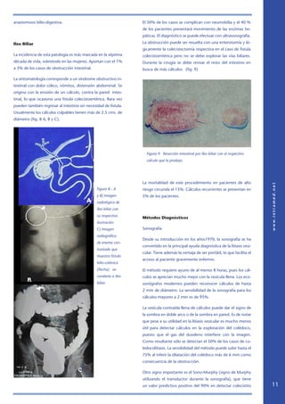 anastomosis bilio-digestiva.                                     El 50% de los casos se complican con neumobilia y el 40 %
                                                                 de los pacientes presentará movimiento de las enzimas he-
                                                                 páticas. El diagnóstico se puede efectuar con ultrasonografía.

Ileo Biliar                                                      La obstrucción puede ser resuelta con una enterotomía y ló-
                                                                 gicamente la colecistectomía respectiva en el caso de fìstula
La incidencia de esta patología es más marcada en la séptima     colecistoentérica pero no se debe explorar las vías biliares.
década de vida, sobretodo en las mujeres. Aportan con el 1%      Durante la cirugía se debe revisar el resto del intestino en
a 3% de los casos de obstrucción intestinal.                     busca de más cálculos. (fig. 9)

La sintomatología corresponde a un síndrome obstructivo in-
testinal con dolor cólico, vómitos, distensión abdominal. Se
origina con la erosión de un cálculo, contra la pared intes-
tinal, lo que ocasiona una fístula colecistoentérica. Rara vez
pueden también ingresar al intestino sin necesidad de fístula.
Usualmente los cálculos culpables tienen más de 2.5 cms. de
diámetro (fig. 8 A, B y C).




                                                                   Figura 9. Resección intestinal por íleo biliar con el respectivo
                                                                   cálculo que lo produjo.




                                                                 La mortalidad de este procedimiento en pacientes de alto
                                               Figura 8.- A      riesgo circunda el 15%. Cálculos recurrentes se presentan en
                                               y B) Imagen       5% de los pacientes.
                                               radiológica de
                                               íleo biliar con
                                               su respectiva
                                                                 Métodos Diagnósticos
                                               ilustración.
                                               C) Imagen         Sonografía
                                               radiográfica
                                                                 Desde su introducción en los años1970, la sonografía se ha
                                               de enema con-
                                                                 convertido en la principal ayuda diagnóstica de la litiasis vesi-
                                               trastado que
                                                                 cular. Tiene además la ventaja de ser portátil, lo que facilita el
                                               muestra fístula
                                                                 acceso al paciente gravemente enfermo.
                                               bilio-colónica
                                               (flecha) se-      El método requiere ayuno de al menos 8 horas, pues los cál-
                                               cundaria a íleo   culos se aprecian mucho mejor con la vesícula llena. Los eco-
                                               biliar.           sonógrafos modernos pueden reconocer cálculos de hasta
                                                                 2 mm de diámetro. La sensibilidad de la sonografía para los
                                                                 cálculos mayores a 2 mm es de 95%.

                                                                 La vesícula contraída llena de cálculos puede dar el signo de
                                                                 la sombra en doble arco o de la sombra en pared. Es de notar
                                                                 que pese a su utilidad en la litiasis vesicular es mucho menos
                                                                 útil para detectar cálculos en la exploración del colédoco,
                                                                 puesto que el gas del duodeno interfiere con la imagen.
                                                                 Como resultante sólo se detectan el 50% de los casos de co-
                                                                 ledocolitiasis. La sensibilidad del método puede subir hasta el
                                                                 75% al inferir la dilatación del colédoco más de 6 mm como
                                                                 consecuencia de la obstrucción.

                                                                 Otro signo importante es el Sono-Murphy (signo de Murphy
                                                                 utilizando el transductor durante la sonografía), que tiene
                                                                 un valor predictivo positivo del 90% en detectar colecistitis        11
 