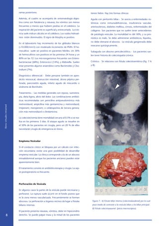 ramas posteriores.                                                 tienen fiebre. Hay tres formas clínicas:

                            Además, el cuadro se acompaña de sintomatología diges-             Aguda con peritonitis biliar.- Se asocia a enfermedades sis-
                            tiva como son flatulencia y náuseas; los vómitos son menos         témicas como inmunodeficiencias, insuficiencia vascular,
                            frecuentes a menos que hubiere piedras en el colédoco. La          arteriosclerosis, diabetes mellitus, cirrosis, enfermedades del
                            respiración del paciente es superficial y entrecortada. La icte-   colágeno. Son pacientes que no suelen tener antecedentes
                            ricia suele indicar cálculos en el colédoco. Los ruidos hidroaé-   de patología vesicular. La mortalidad es del 30%, y su pro-
                            reos están disminuidos. El signo de Murphy es positivo.            nóstico es malo. Se debe administrar antibióticos, líquidos,
                                                                                               no debe drenarse el absceso. La vesícula gangrenada debe
                            En el laboratorio hay incremento de los glóbulos blancos
                                                                                               resecarse quirúrgicamente.
                            (10.000/mm3) con moderado incremento de PMN. El he-
                            mocultivo suele ser positivo en pacientes febriles. Un 30%         Subaguda con absceso pericolecistìtico.- Los pacientes sue-
                            de hemocultivos son positivos en las primeras 24 horas y un        len tener historia de colecistopatía crónica.
                            80% en las 72. Los microorganismos frecuentes son Entero-
                            bacteriaceae (68%), Enterococci (14%), y Klebsiella. Suelen        Crónica.- Se relaciona con fístula colecistoentérica (fig. 7 A
                            estar presentes algunos anaerobios como Bacteroides y Clos-        y B).
                            tridium (7%).

                            Diagnóstico diferencial.- Debe pensarse también en apen-
                            dicitis retrocecal, obstrucción intestinal, úlcera péptica per-
                            forada, pancreatitis aguda, infarto agudo de miocardio o
                            síndrome de Bornholm.

                            Tratamiento.- Las medidas generales son reposo, suerotera-
                            pia, dieta ligera, alivio del dolor. Las combinaciones antibió-
                            ticas recomendadas son penicilina antipseudomónica más
                            metronidazol; ampicilina más gentamicina y metronidazol;
libros virtuales intramed




                            imipenem; meropenem; o cefalosporina de tercera genera-
                            ción más metronidazol o clindamicina.

                            La colecistectomía tiene mortalidad cercana al 0.5% si se rea-
                            liza en los primeros 3 días. El ataque agudo se resuelve en
                            el 50% de los pacientes sin cirugía, pero un 20 % de ellos
                            necesitarán cirugía de emergencia en breve.




                            Empiema Vesicular

                            Si el conducto cístico se bloquea por un cálculo con infec-
                            ción secundaria; existe una gran posibilidad de desarrollar
                            empiema vesicular. La clínica corresponde a la de un absceso
                            intraabdominal aunque los pacientes ancianos pueden estar
                            aparentemente bien.

                            El tratamiento consiste en antibióticoterapia y cirugía. La sep-
                            sis postoperatoria es frecuente.




                            Perforación de Vesícula

                            En algunos casos la partes de la vesícula puede necrosarse y
                            perforarse. La ruptura suele ocurrir en el fondo puesto que
                            es la zona menos vascularizada. Frecuentemente se forman
                            abscesos. La perforación a órganos vecinos da lugar a fístulas      Figura 7.- A) Fístula biliar interna (colecistoduodenal) por la cual
                            biliares internas.                                                  pasa medio de contraste a la vesícula biliar y vía biliar principal.
                                                                                                B) Fístula colecistoyeyunal (pieza macroscópica).
                            El paciente presenta náuseas, vómitos, dolor en hipocondrio
                           derecho. Se puede palpar masa y la mitad de los pacientes
 