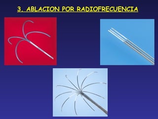3. ABLACION POR RADIOFRECUENCIA
