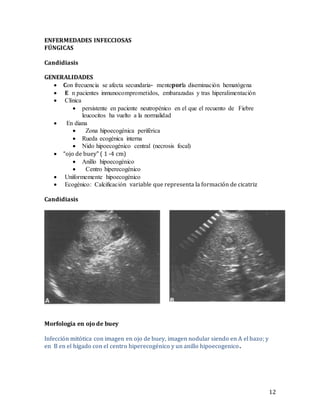12
ENFERMEDADES INFECCIOSAS
FÚNGICAS
Candidiasis
GENERALIDADES
 Ce lsoisui smCl cilCsismClcisu oComC- ti mil por ltClomcitm Csm l iitCm ci C
 E laCsmi micl m tu esetaoetimmoec,l itcCoCdCoCcl tlmoCclimaioCtmti mCsml
 atc msC
 emicoilaiocmcmi mil i laCsmi mil iumoea msel i litlnuilitloisui mel oil
tiusesmmecl iClpuitmel CltCl eotCtmoCo
 l l lomC C
 ae Climaeisec msCl aioms omsCl
 suioClisec msCl m mio C
 moelimaeisec msel si moCtl ) isoecmcl sesCt(
 “ojo de buey” ( 1 -4 cm)
 l mttel imaeisec mse
 ai moelimaioisec msel
 o mseotiti mil imaeisec mse
 lsec mseul aCtsmsmsCsm n variable que representa la formación de cicatriz
Candidiasis
Morfología en ojo de buey
Infección mitótica con imagen en ojo de buey, imagen nodular siendo en A el bazo; y
en B en el hígado con el centro hiperecogénico y un anillo hipoecogenico.
 