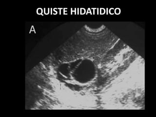 QUISTE HIDATIDICO
 