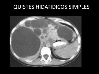 QUISTES HIDATIDICOS SIMPLES
 