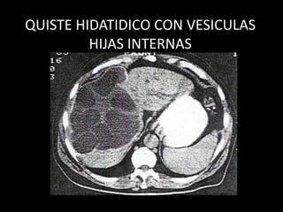QUISTE HIDATIDICO CON VESICULAS
HIJAS INTERNAS
 