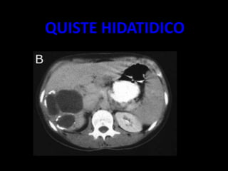 QUISTE HIDATIDICO
 