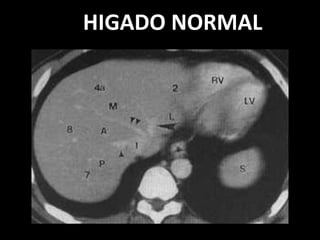 HIGADO NORMAL
 