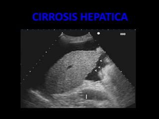 CIRROSIS HEPATICA
 