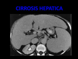 CIRROSIS HEPATICA
 