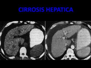 CIRROSIS HEPATICA
 