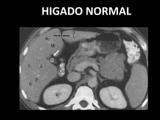 HIGADO NORMAL
 