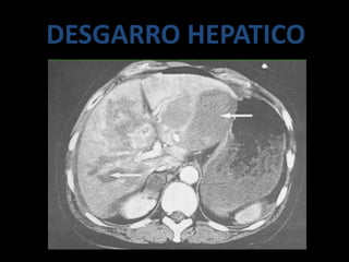 DESGARRO HEPATICO
 