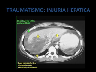 TRAUMATISMO: INJURIA HEPATICA
 