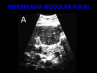 HIPERPLASIA NODULAR FOCAL
 