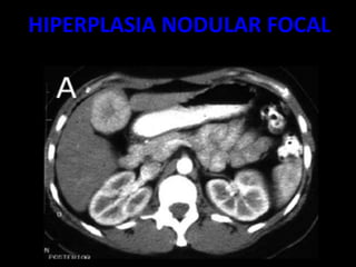 HIPERPLASIA NODULAR FOCAL
 