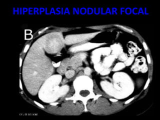 HIPERPLASIA NODULAR FOCAL
 