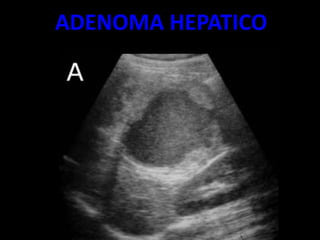 ADENOMA HEPATICO
 