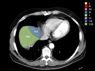 I
II
III
IV
V
VI
VII
VIII
IVa
VIII
VII
 