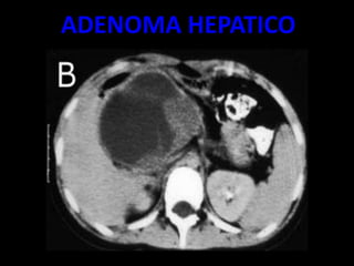 ADENOMA HEPATICO
 