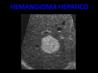 HEMANGIOMA HEPATICO
 