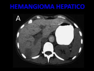HEMANGIOMA HEPATICO
 