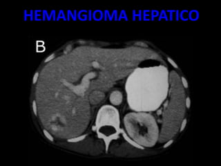 HEMANGIOMA HEPATICO
 